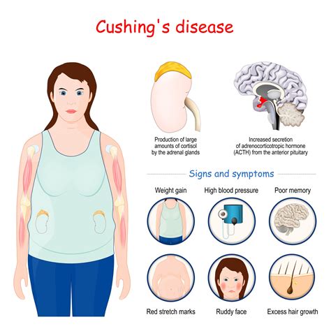 Treating cushing - Jun 16, 2021 · Cushing’s disease is a syndromic pathological condition caused by adrenocorticotropic hormone (ACTH)-secreting pituitary adenomas (ACTHomas) mediated by hypercortisolemia. It may have a severe clinical course, including infection, psychiatric disorders, hypercoagulability, and metabolic abnormalities, despite the generally small, nonaggressive nature of the tumors. Up to 20% of ACTHomas show ... 
